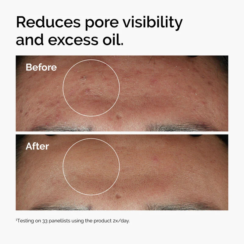 Niacinamide 10% + Zinc 1% (Imported Serum)